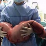 Após dores abdominais, jovem passa por cirurgia para remoção de 13 kg de fezes do intestino