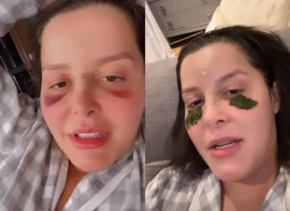 Maraísa mostra rosto após acidente na piscina e nariz fraturado