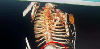 Mulher de 86 anos descobre feto mumificado no útero após 56 anos