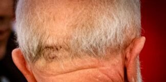 Lula passa por cirurgia de emergência após hemorragia no crânio