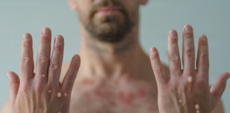 DF registra primeiro caso de mpox em 2026