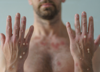 DF registra primeiro caso de mpox em 2026