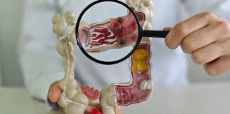 Em 13 anos, doença inflamatória intestinal cresce 5 vezes no Brasil