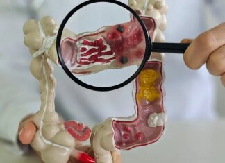 Em 13 anos, doença inflamatória intestinal cresce 5 vezes no Brasil