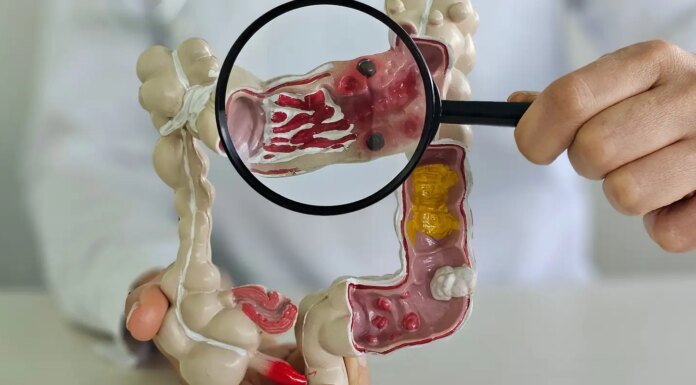 Em 13 anos, doença inflamatória intestinal cresce 5 vezes no Brasil