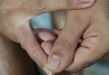 Dermatite atópica impacta pele, sono e autoestima: saiba como tratar