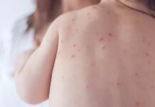 São Paulo confirma mais dois casos de sarampo e total chega a 32