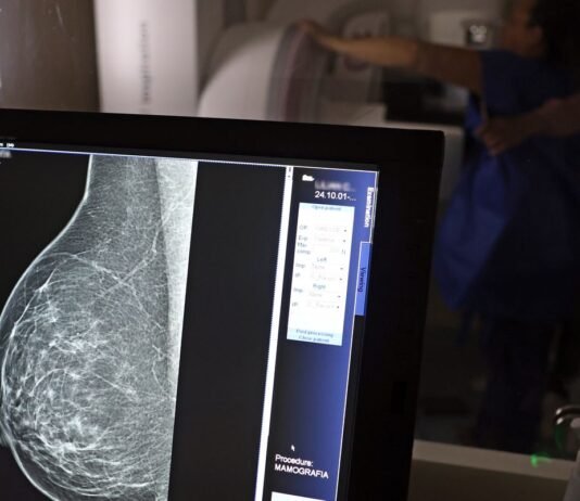 Entidades alertam médicos sobre pedidos de mamografia digital
